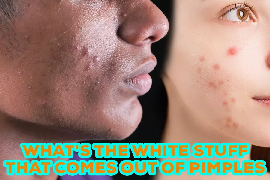 what-s-the-white-stuff-that-comes-out-of-pimples-a-comprehensive-guide